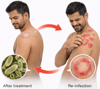Fungal infection reinfection cycle caused by infected clothes and skin contact